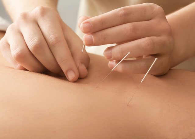 bigstock Young man getting acupuncture